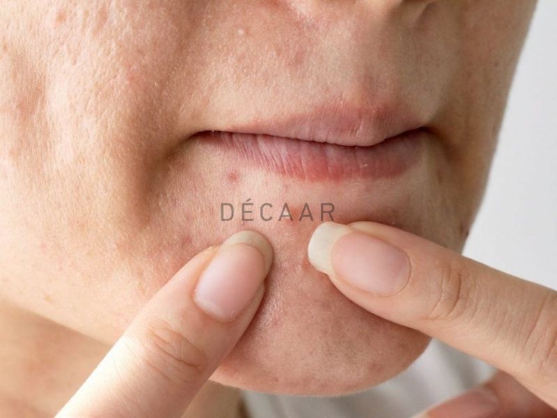 mụn đầu trắng có nên nặn không